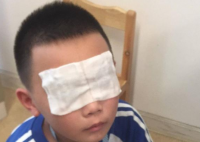 小学误开紫外线灯灼伤学生眼睛 小学生眼睛被灼伤的厉害吗会影响视力吗？
