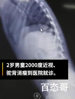 2岁男童近视两千多度 医生有说怎么治这种近视吗？