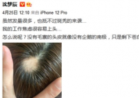 沈梦辰因过度焦虑斑秃 沈梦辰个人资料简介及家世
