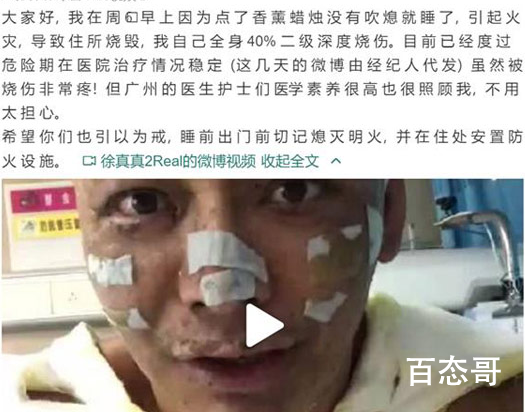 歌手徐真真全身二级深度烧伤 徐真真复出还有希望吗