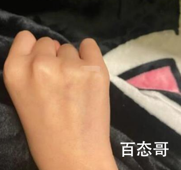 两网友自称在广州街头被人扎针 一到关键时候监控就不清楚了