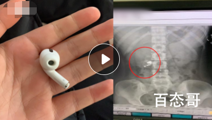 女孩睡觉时听歌误吞耳机隔天排出 晚上做梦情到深处醒了才知道吞错了