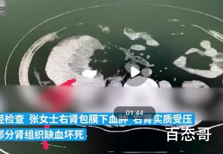 女子用按摩仪减肥把肾压扁进ICU 到底是什么情况