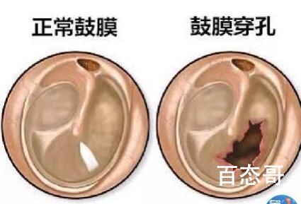 男子打蚊子把自己左耳鼓膜打穿孔 注意力度不需要那么大力也可以拍死