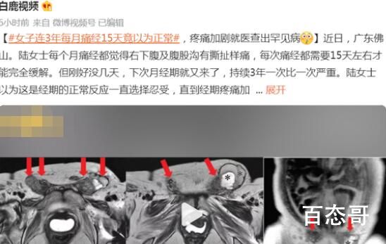女子连续3年每月痛经15天以为没事  每次痛经都跟渡劫一样疼的死去活来