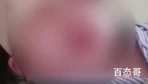 5岁女童遭狗咬毁容 犬主系公职人员 把孩子的大好童年和健康还给她！