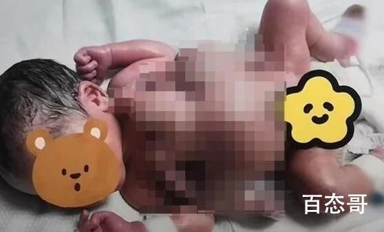 深圳一男婴出生时四手四脚 当时产前筛查没有查出来吗