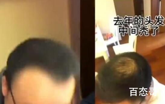 男子回应“不用洗发水变满头黑发” 与头发油新的产品有关？