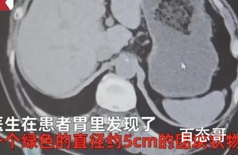 男子胃结石医生开药2大瓶可乐 雪碧表示不服 