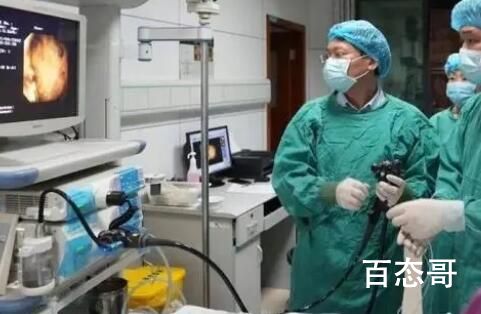 3岁女孩连吃8个柿子长胃结石 注意孩子的饮食安全
