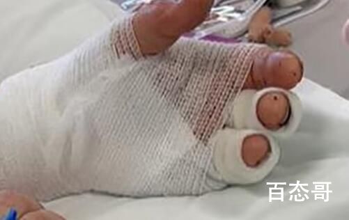 瑞士工人跌入720℃熔炉爬出生还 自己救自己真是求生欲满满
