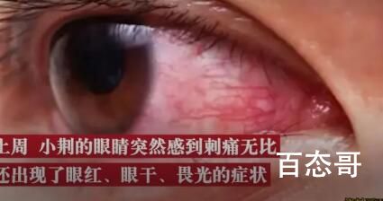 女子戴隐形10年角膜长满新生血管 隐形眼镜本来就不是天天带那么久的