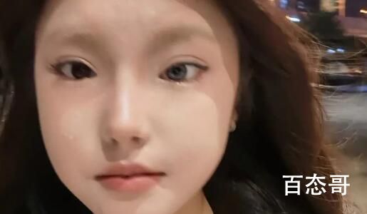 18岁女孩右眼天生蓝瞳 异色瞳这可不是想要就有的