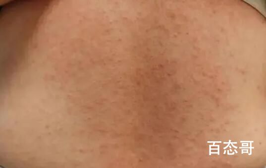 女子混吃7种感冒止咳药全身长满脓疱 这背后原因让人惊愕