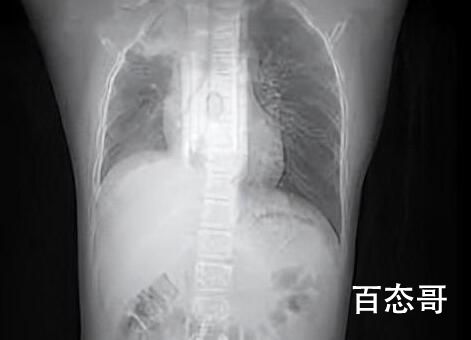 男孩咳嗽发热在家硬扛成白肺 背后的真相让人惊愕