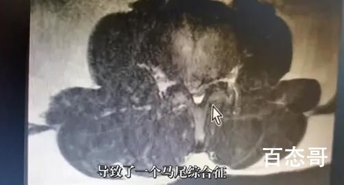 男子长期久坐后被诊断截瘫 白天坐十个小时的路过