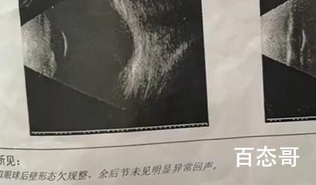 父母高度近视1岁婴儿近视600度 背后的真相让人震惊