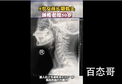 9岁女孩沉迷手机颈椎老如50岁 其实应该禁止小孩接触手机