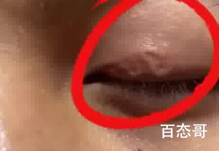 男子左眼皮异常抖动有虫游走 吓得我赶紧往眼睛里喷了半瓶杀虫剂