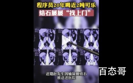 程序员20年喝近2吨可乐屡患结石 牙齿基本上也掉完了