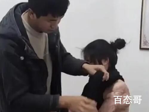 男子照顾大面积烧伤女友6年 有爱心有责任心这才是中华美德