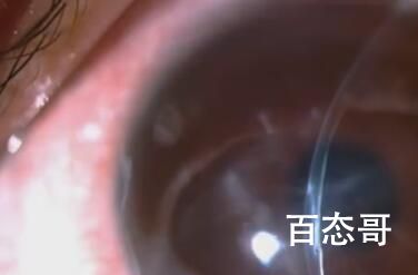 15岁男孩爱揉眼2次揉掉视网膜 背后的真瞎让人始料未及