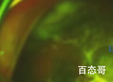15岁男孩爱揉眼2次揉掉视网膜 背后的真瞎让人始料未及