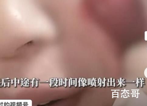 男生挤痘流血近1小时:用了400张纸 这种情况必须重视