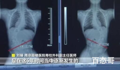仅3周接诊5名下腰瘫痪孩子 究竟是怎么一回事